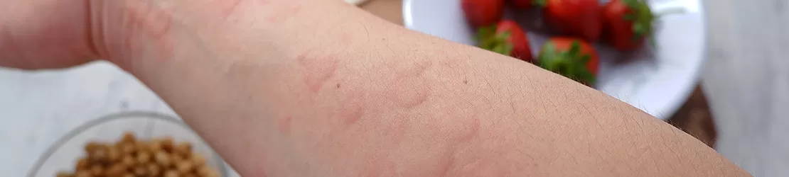 Mana afectata de urticarie cauzata de alergia la capsune