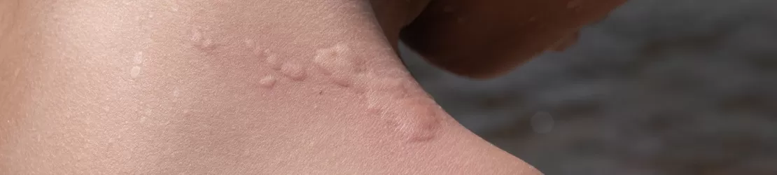 Reactie alergica la apa