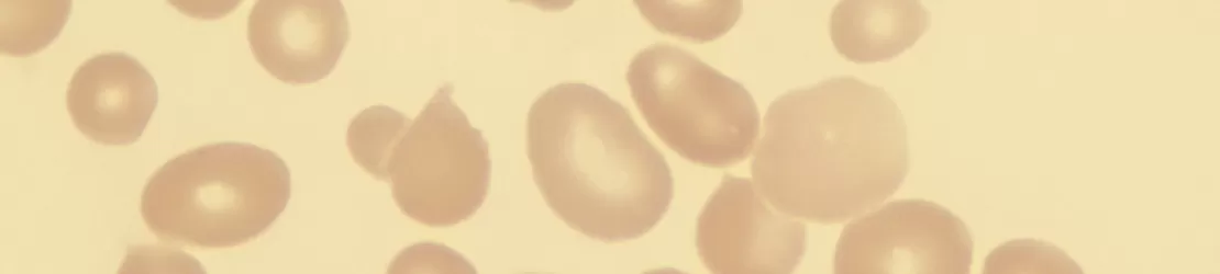 Imagine microscopica a sangelui care arata macro-ovalocite, celule caracteristice anemiei pernicioase