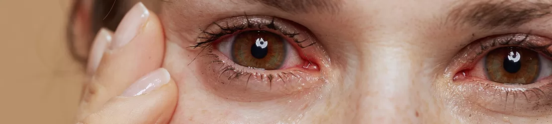 Ochi inflamat in timpul unei infectii oculare, cu sclera inrosita si iritata