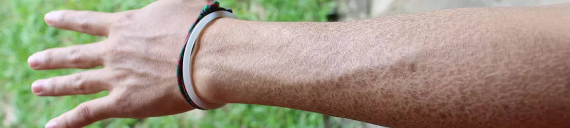 Piele afectata de ihtioza vulgaris, o boala genetica ce cauzeaza uscaciune si solzi