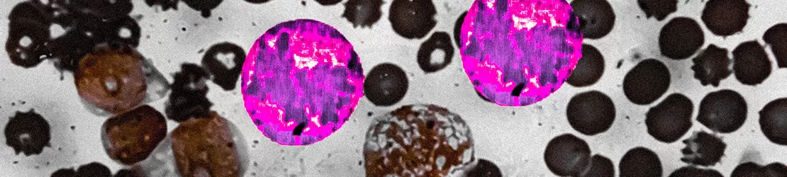Studiu de maduva osoasa (BMD) aratand trombocitopenie amegacariocitara la microscop