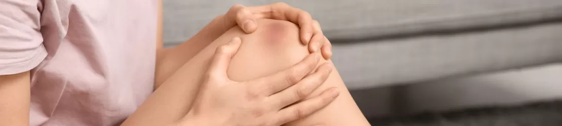 Vanatai vizibile pe picioarele unei femei tinere, indicand posibil un traumatism recent sau o afectiune hematologica