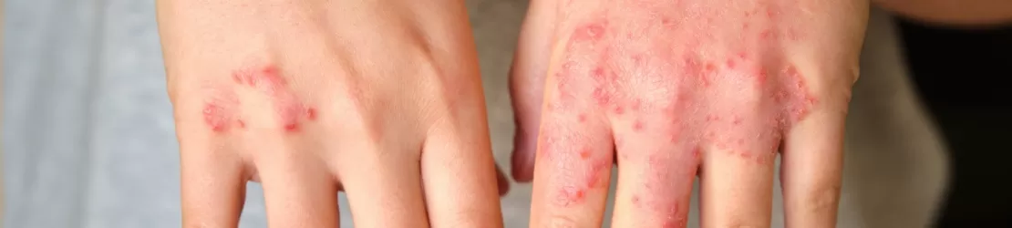 Mainile afectate de eczema atopica ale unei femei, cu piele uscata si inflamata