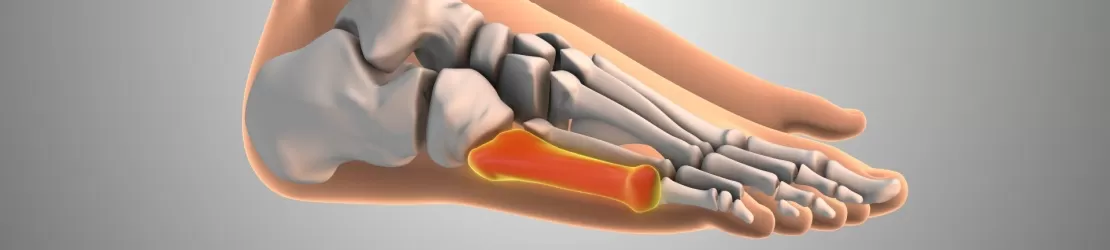Ilustratie a durerii neuropatice asociate metastazelor osoase, cu senzatii de arsura si furnicaturi