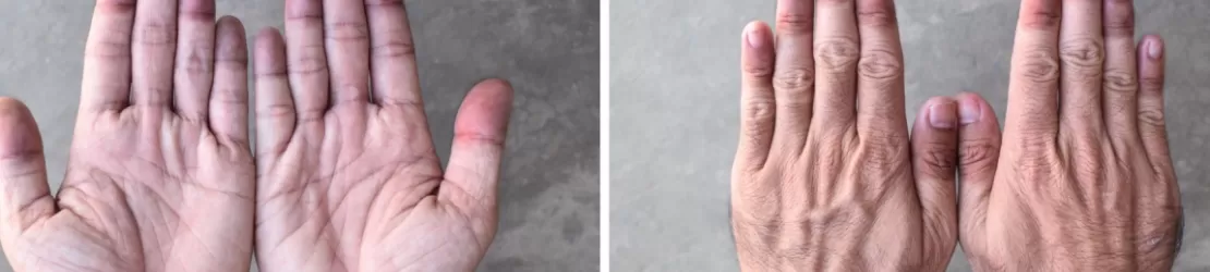 Maini cianotice cu degete albastre la o persoana cu cianoza periferica