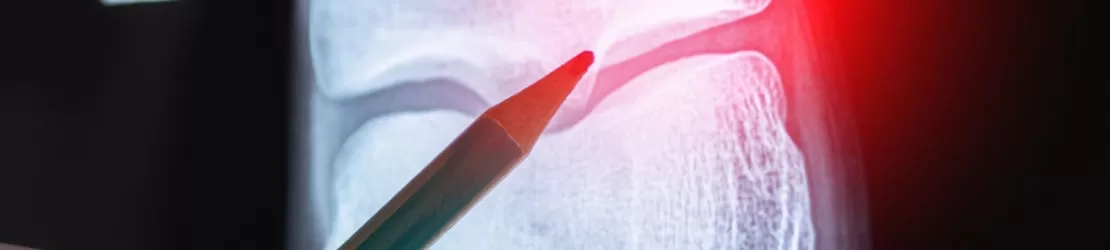 Medic care examineaza radiografia unui pacient cu un osteom osteoid, tumora osoasa benigna, pentru evaluare medicala