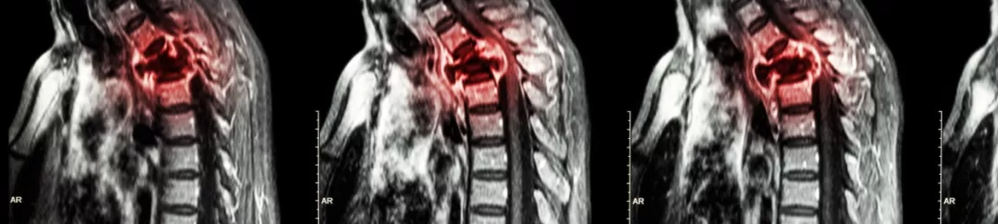 RMN toracic care arata metastaze vertebrale in coloana vertebrala toracica