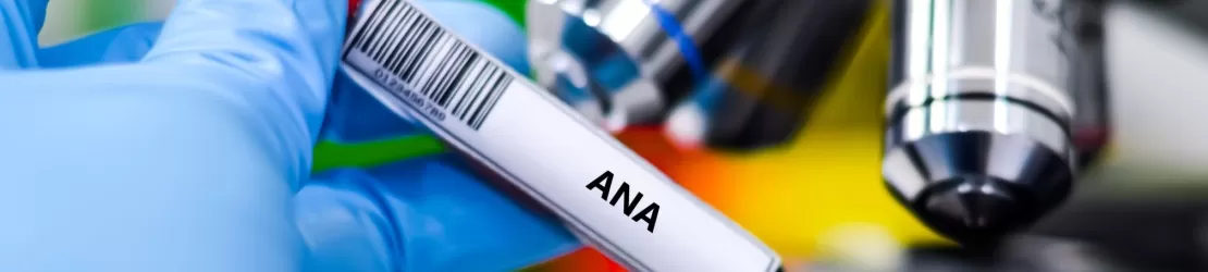 Proba de sange pentru testul ANA pentru diagnosticarea lupusului