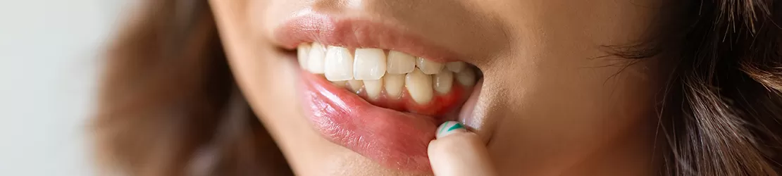 Concept de gingivita, tanara care isi trage buza pentru a arata inflamatie si probleme la gingii