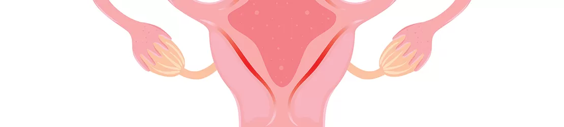 Ilustratie stiintifica care prezinta endometrita, evidentiind inflamarea mucoasei uterine si simptomele asociate