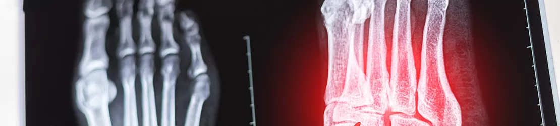 Medic care analizeaza o radiografie a piciorului si degetelor pentru a evalua structurile osoase si posibile afectiuni