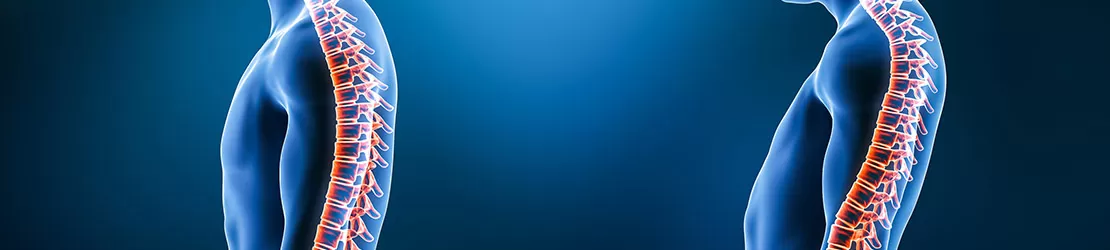 Comparatie intre coloana vertebrala normala si coloana cu lordoza, ilustrand curbura excesiva a spatelui si diferentele anatomice pentru educatie medicala sau fizioterapie.