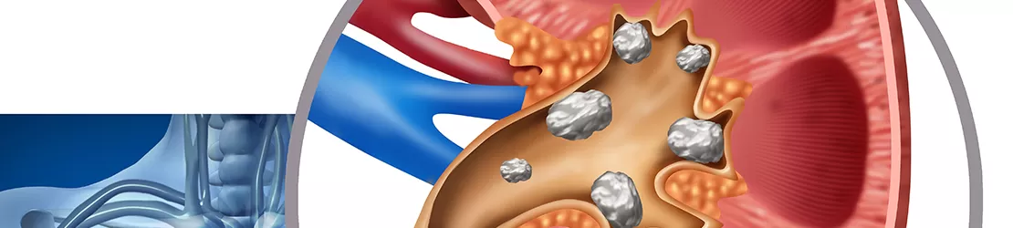 Ilustratie medicala a nefrolitiazei, prezentand depozite de calculi renali si formarea pietrelor la rinichi