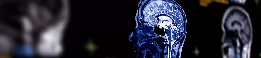 Imagine RMN a creierului in plan sagital, cu detalii selective, ilustrand structura interna a creierului pentru diagnosticul cavernomului cerebral.