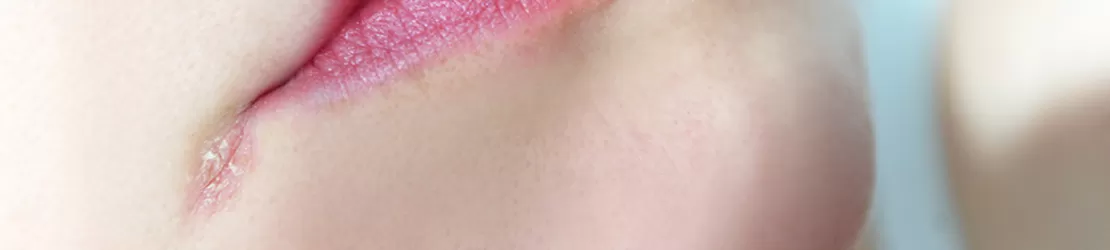 Inflamatie la coltul gurii cauzata de lipsa vitaminelor, evidentiind fisuri si iritatii specifice cheilitei angulare si importanta suplimentarii nutritionale pentru sanatatea pielii.