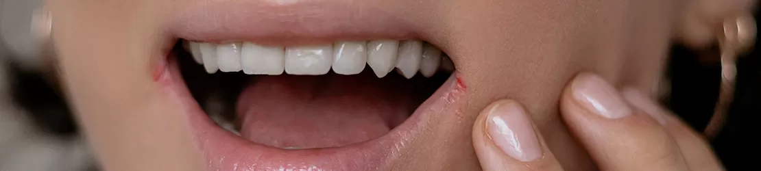 Prim plan cu femeie care prezinta leziuni si disconfort la nivelul gurii, ilustrand simptome asociate cu afectiunea numita cheilita angulara si necesitatea consultului medical pentru tratament adecvat.