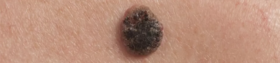 Imaginea unui carcinom cu celule scuamoase keratinizate pe pielea unui pacient care prezinta simptome asociate carcinomului scuamos