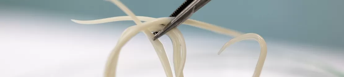 Imagine medicala care ilustreaza ascaridioza, o infectie cauzata de viermi intestinali, evidentiind parazitul si efectele acestuia asupra organismului uman