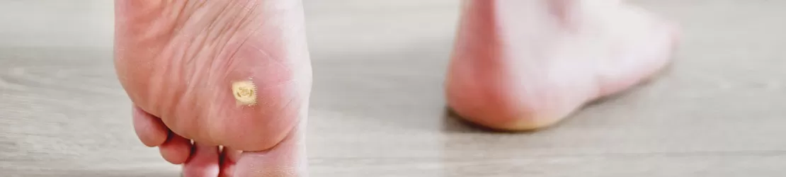 Prim-plan cu neg plantar pe talpa piciorului, ilustrand o afectiune cutanata comuna.