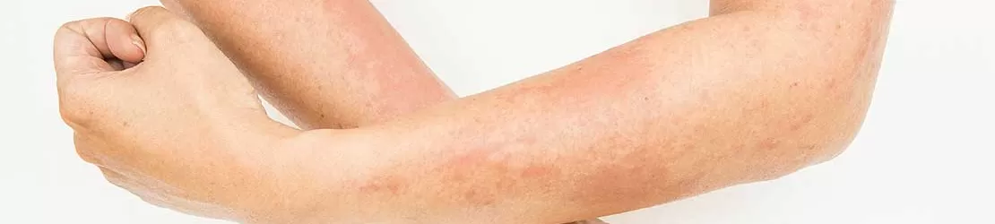 Dermatită de contact