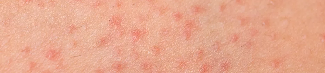 foliculita