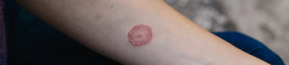 imagine cu un brat cu afectare cutanata produsa de pecingine