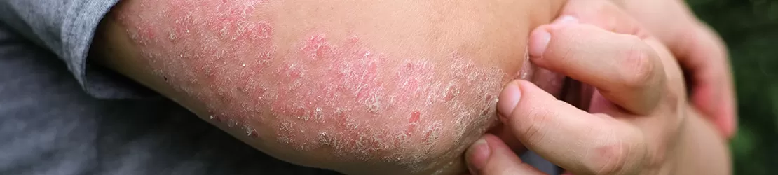 Psoriazis