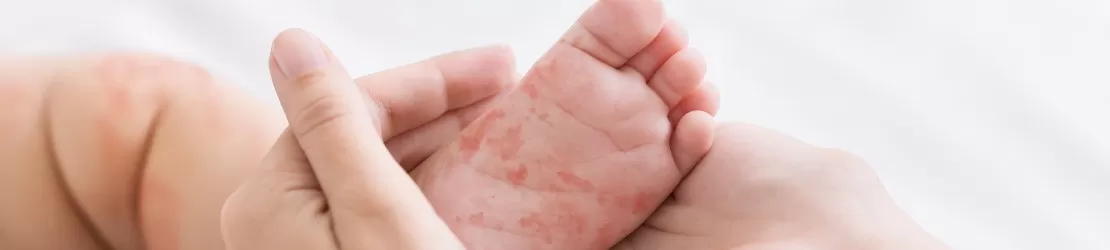 femeie tinand in palme piciorul unui bebelus cu eruptie pe piele cauzata de rubeola