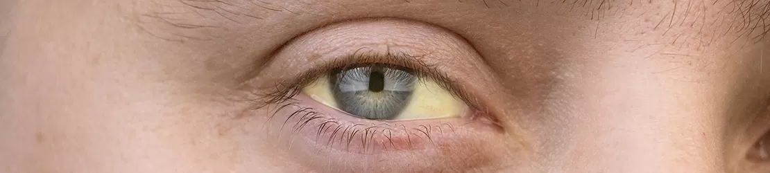 closeup al unui ochi cu albul ochiului ingalbenit, specific sindromului Gilbert”