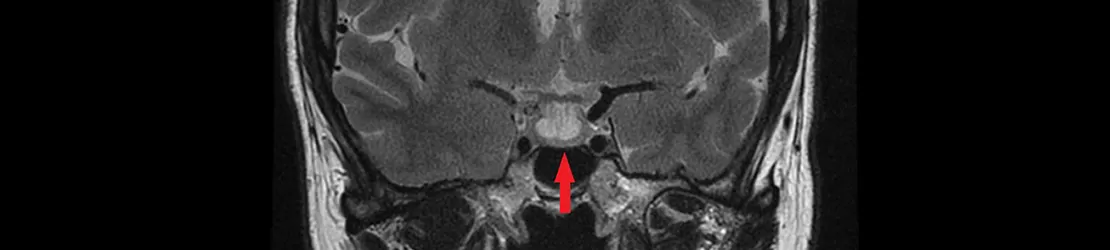 Scan RMN al creierului cu glanda hipofiza indicata printr-o sageata rosie