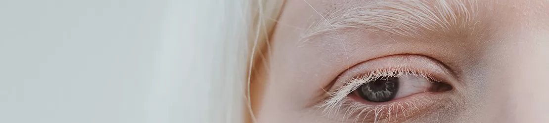 ochi, gene si sprancene ale unei persoane cu albinism