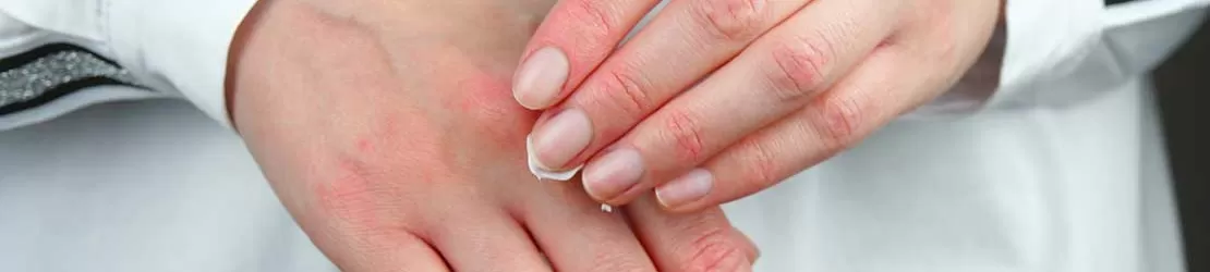 Dermatită de contact 1