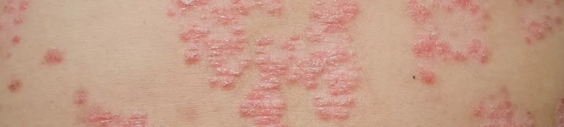 Psoriazis 1
