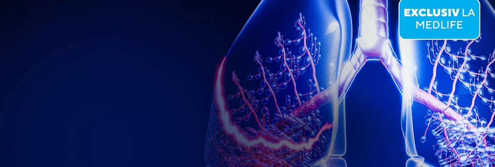 Early CDT: test de screening pentru cancer pulmonar