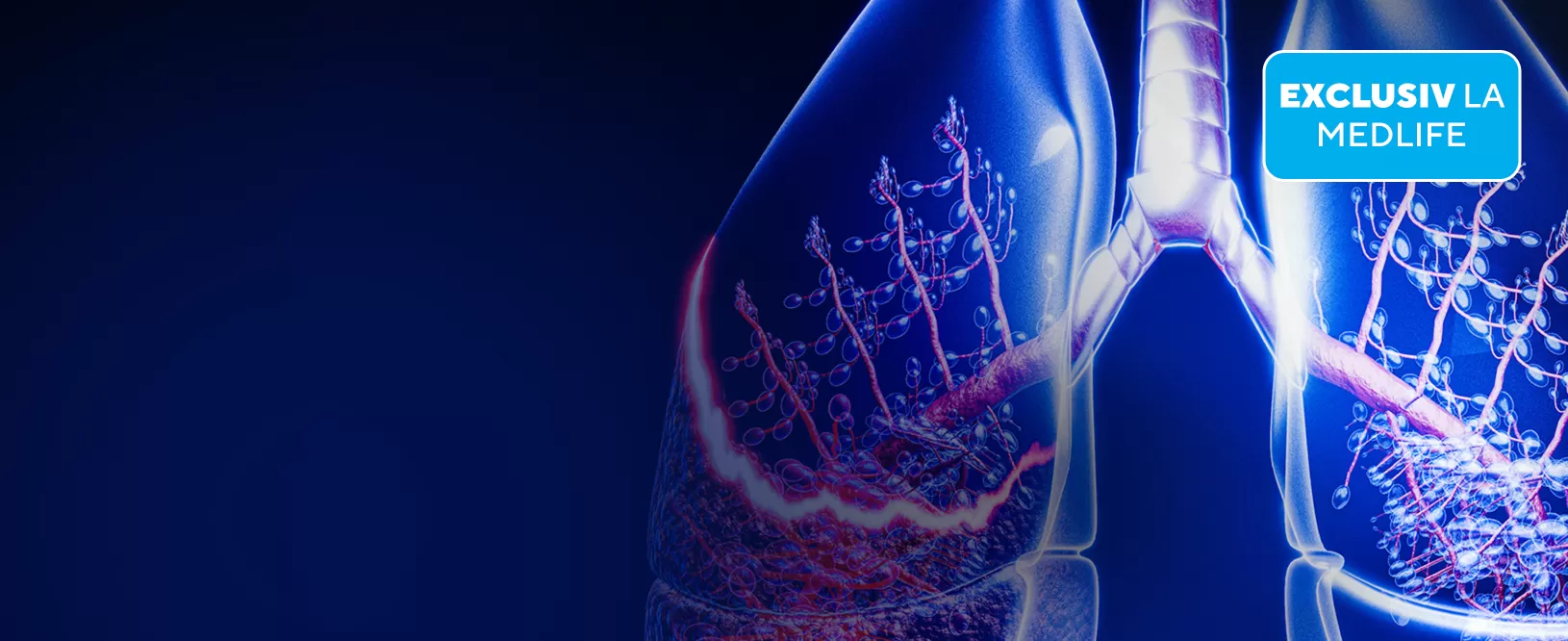 Early CDT: test de screening pentru cancer pulmonar